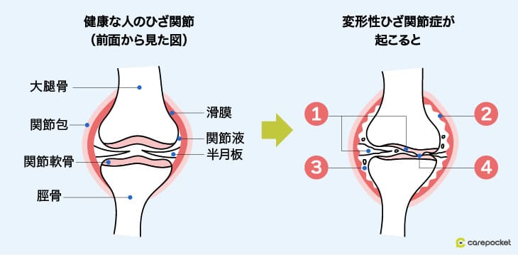 変形性膝関節症の説明